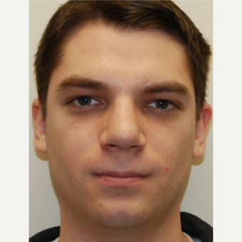 25-34 year old man treated with Rhinoplasty after 3792776