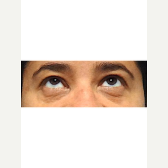 45-54 year old woman treated with Fat Transfer before 3653565