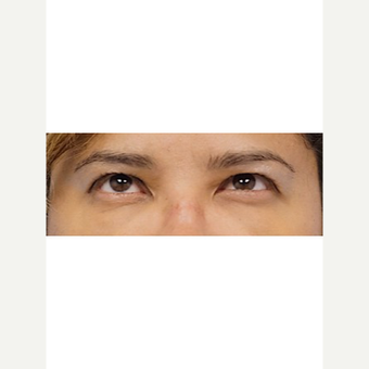 45-54 year old woman treated with Fat Transfer after 3653565