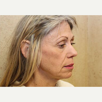 Facelift before 3454848