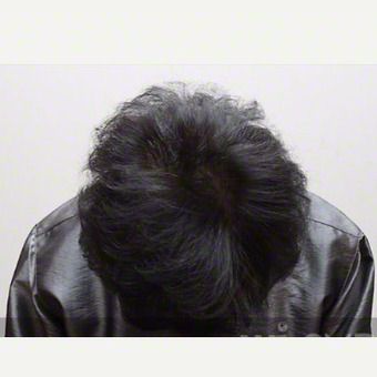35-44 year old woman treated with Scalp Micropigmentation after 2832192