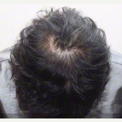 35-44 year old woman treated with Scalp Micropigmentation before 2832192