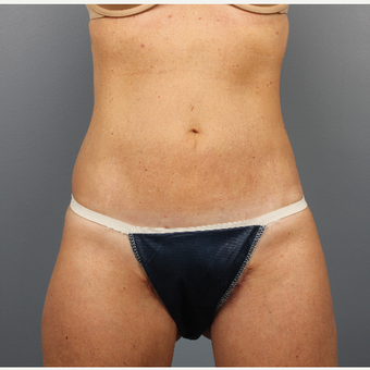 55-64 year old woman treated with CoolSculpting after 3507579