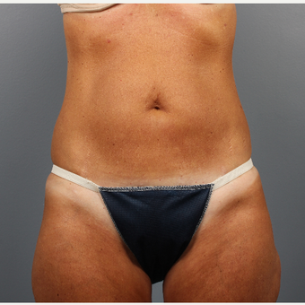 55-64 year old woman treated with CoolSculpting before 3507579