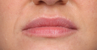 35-44 year old woman treated with Lip Augmentation after 3838976