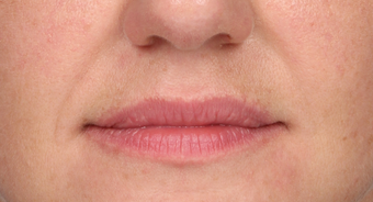 35-44 year old woman treated with Lip Augmentation before 3838976