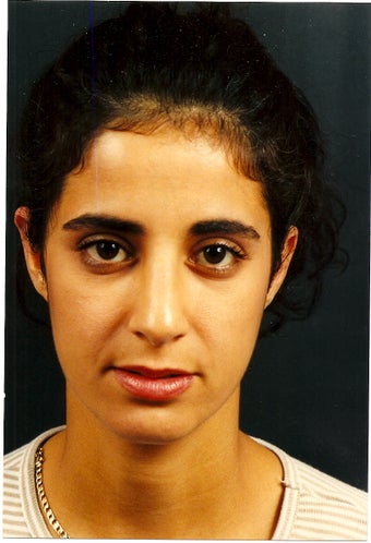 Ear reshaping, or otoplasty, can be for just one or both ears. after 772055