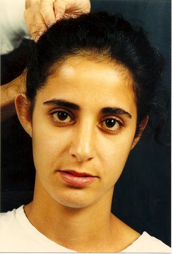 Ear reshaping, or otoplasty, can be for just one or both ears. before 772055