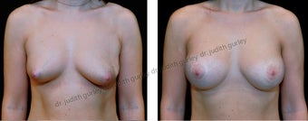 Breast Lift with Implants before 1392157