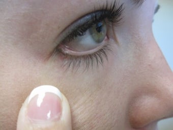 Mole Removal after 1028425