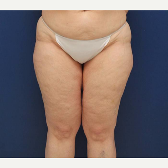 47 year old woman who had excess thigh skin and fat after weight loss before 2998881