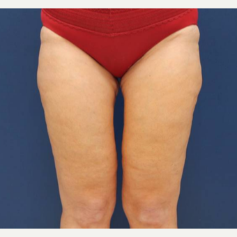 47 year old woman who had excess thigh skin and fat after weight loss after 2998881