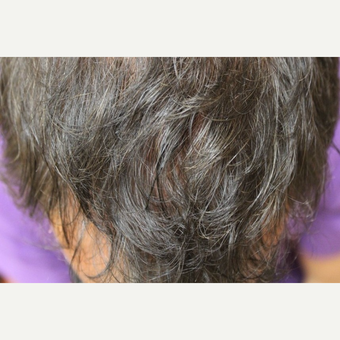 45-54 year old man treated with PRP for Hair Loss after 3385445