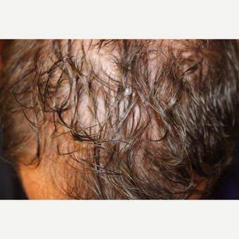 45-54 year old man treated with PRP for Hair Loss before 3385445