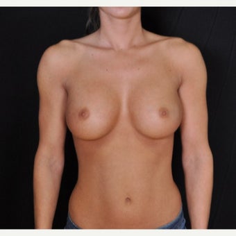 Fiberopic Transaxillary Dual Plane No-Scar on the Breast Technique after 1576299