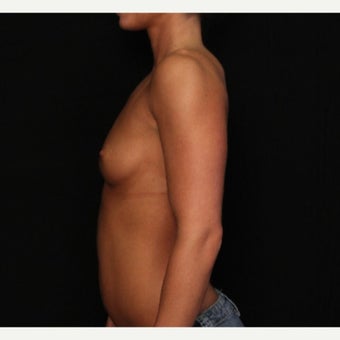 Fiberopic Transaxillary Dual Plane No-Scar on the Breast Technique 1576299