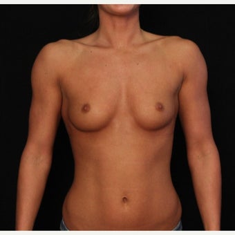 Fiberopic Transaxillary Dual Plane No-Scar on the Breast Technique before 1576299