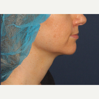 35-44 year old woman treated with ThermiTight after 3138842