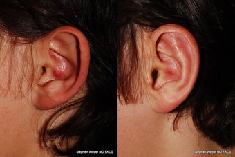 Ear Surgery before 1445741