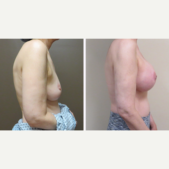 55-64 year old woman treated with Breast Augmentation before 3300024