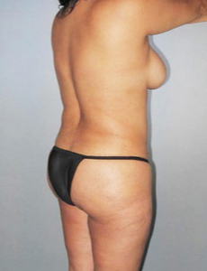 25-34 year old woman treated with Brazilian Butt Lift before 2253131