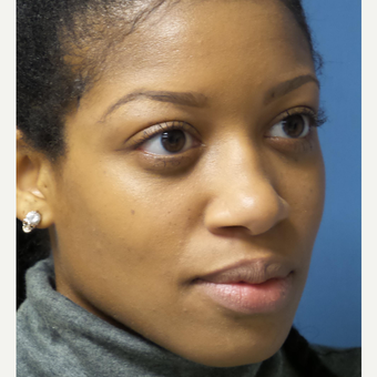 25-34 year old woman treated with African American Rhinoplasty before 3098293