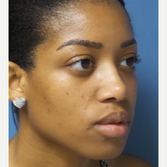 25-34 year old woman treated with African American Rhinoplasty after 3098293