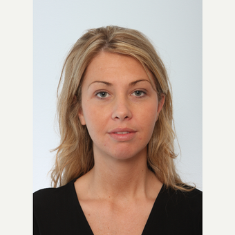 Buccal Fat Removal after 2965123