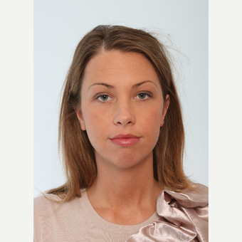 Buccal Fat Removal before 2965123