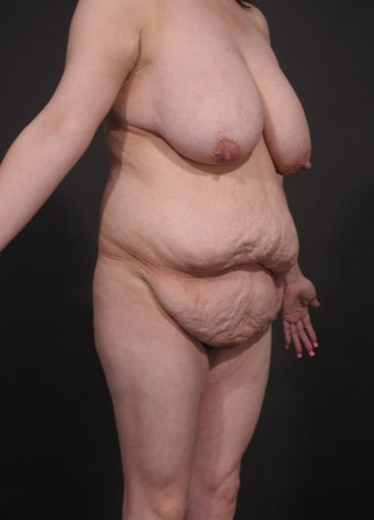 25-34 year old woman treated for Mommy Makeover 1534733