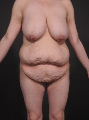 25-34 year old woman treated for Mommy Makeover before 1534733