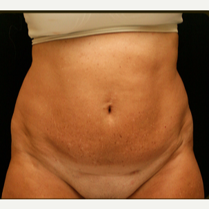 55-64 year old woman treated with Tummy Tuck before 3738082