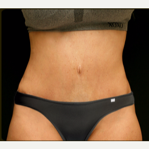 55-64 year old woman treated with Tummy Tuck after 3738082