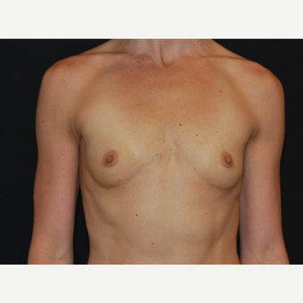 25-34 year old woman treated with Breast Implants before 3651612