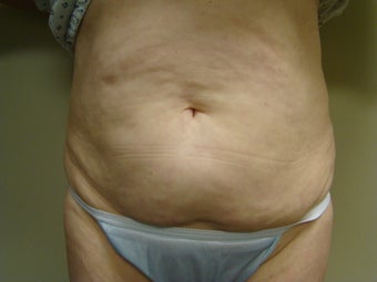 64 Year Old Female - Abdominoplasty before 647336