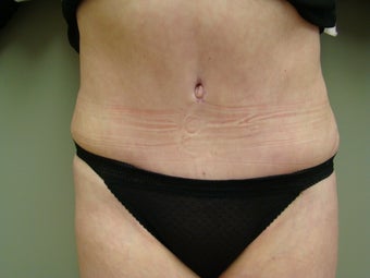 64 Year Old Female - Abdominoplasty after 647336