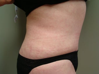 64 Year Old Female - Abdominoplasty 647336