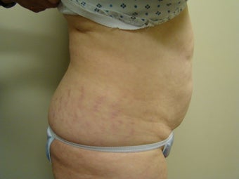 64 Year Old Female - Abdominoplasty 647336