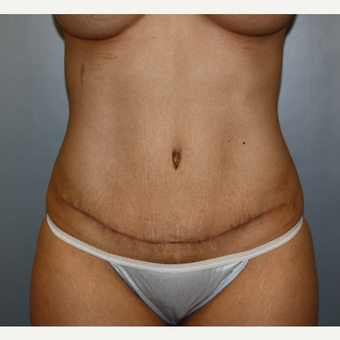 25-34 year old woman treated with Tummy Tuck after 3808894