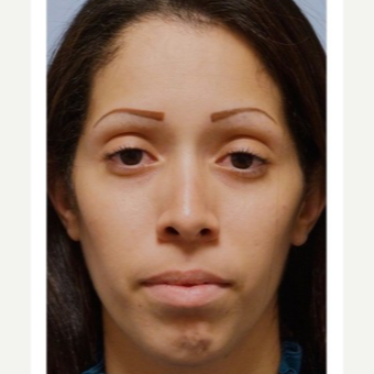 25-34 year old woman treated with Rhinoplasty after 3691930