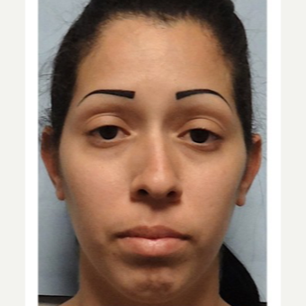25-34 year old woman treated with Rhinoplasty before 3691930