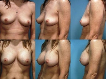 Breast Augmentation before 124500
