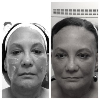 Sculptra before and immediately after before 657308