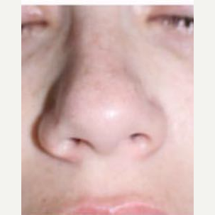 25-34 year old woman treated with Rhinoplasty before 3390208