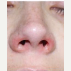 25-34 year old woman treated with Rhinoplasty after 3390208