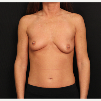 32 year old female with bilateral submuscular silicone implants placed through the underarm before 3575942