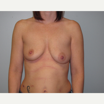 35-44 year old woman treated with Breast Lift with Implants before 3609107