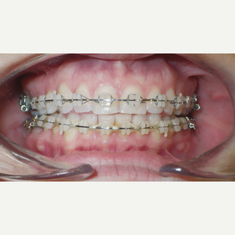 25-34 year old woman treated with Clear Braces before 3465833
