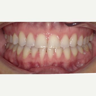 25-34 year old woman treated with Clear Braces after 3465833
