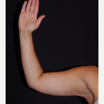 25-34 year old woman treated with Smart Lipo after 2998834